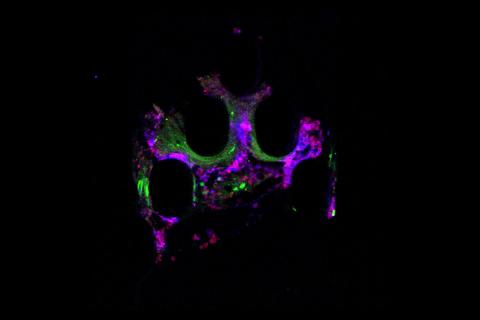 Immune cells (green and red) prepare to destroy a cancer cell (blue, center)